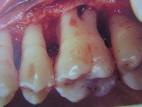 フラップ手術：歯肉、骨膜を剥離し、直視下にて 取り残した歯石を除去し、骨の整形をします。